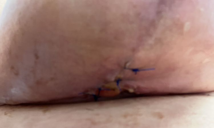 Cómo evitar que se abran los puntos de una mastopexia - 51392