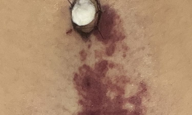 Manchas extrañas por debajo del ombligo tras abdominoplastia - 51625