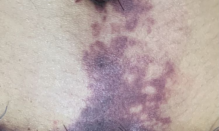 Manchas extrañas por debajo del ombligo tras abdominoplastia - 51626