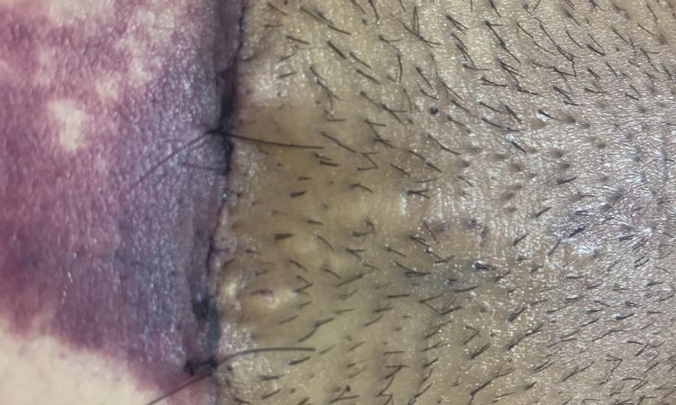 Manchas extrañas por debajo del ombligo tras abdominoplastia - 51627