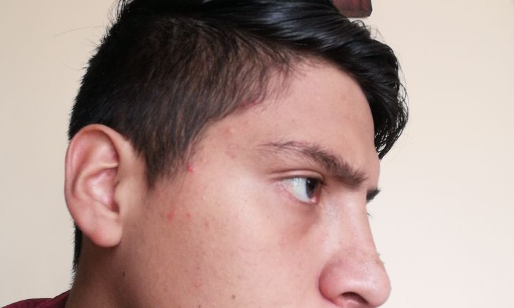 Nariz sigue desviada post rinoseptoplastia - 51721