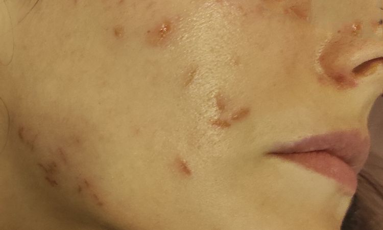 Quemaduras por láser vascular facial - 51822