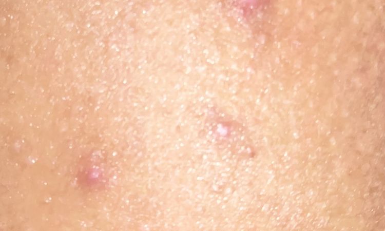 Eliminar granos en los glúteos con peeling químico - 51882