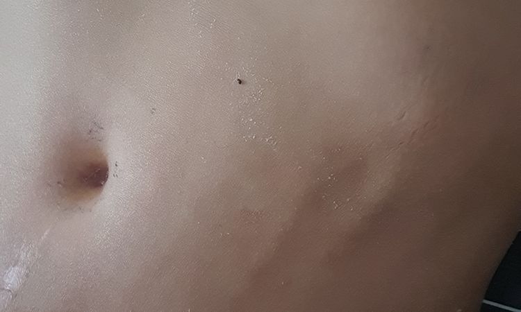 Venas alteradas después de abdominoplastia con lipo y mastopexia - 51888