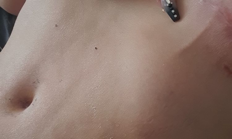 Venas alteradas después de abdominoplastia con lipo y mastopexia - 51889