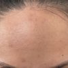 Eliminar piel grasa, acné, manchas y cicatrices en el rostro