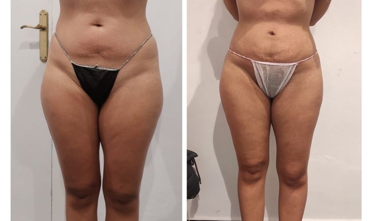 Me hice lipotransferencia hace 2 meses y no veo resultados - 52041