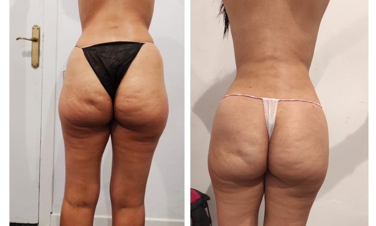 Me hice lipotransferencia hace 2 meses y no veo resultados - 52042