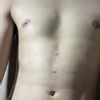 Dos meses post marcación abdominal sin resultado