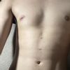 Dos meses post marcación abdominal sin resultado - 52222