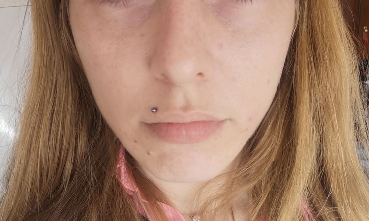 A qué se puede deber todo este brote de acné? Cómo puedo solucionarlo? - 52458