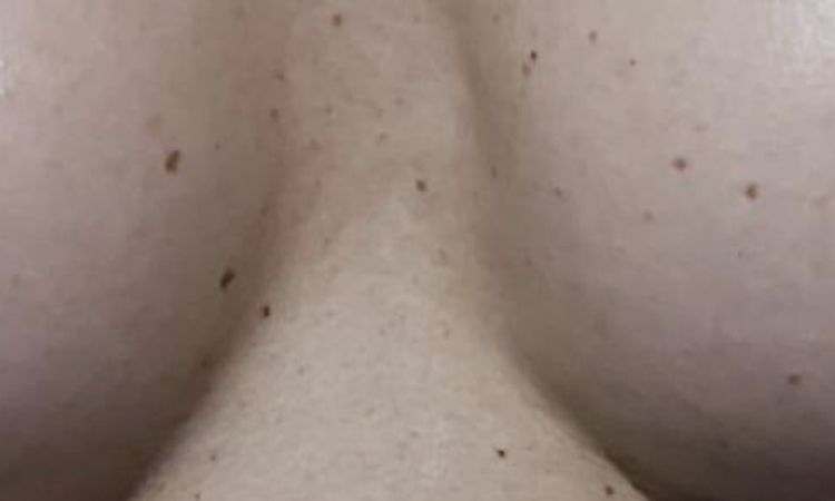 Mala cicatrización o encapsulamiento tras aumento de pecho en canalillo? - 52506