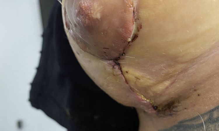 Va todo bien con las cicatrices de mi mastopexia?? - 52583