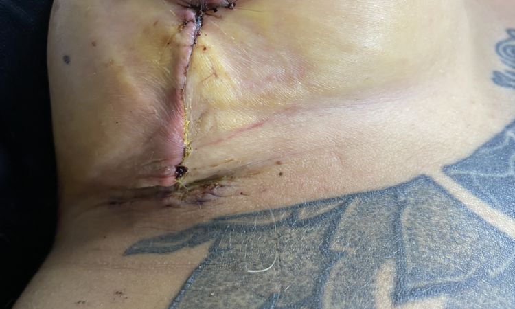 Va todo bien con las cicatrices de mi mastopexia?? - 52584
