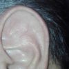 Cirugía para reducir el tamaño de las orejas - 52602
