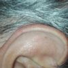 Cirugía para reducir el tamaño de las orejas - 52607