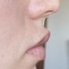Se arreglará la boca de pato tras el retoque del aumento de labios?