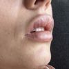 Se arreglará la boca de pato tras el retoque del aumento de labios?