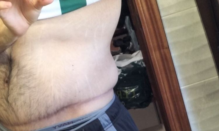 Eliminar grasa localizada en flancos y espalda baja tras abdominoplastia - 52679