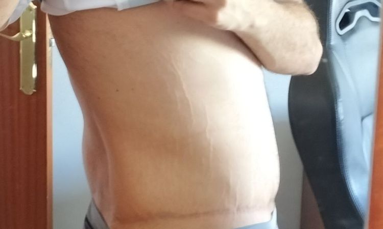 Eliminar grasa localizada en flancos y espalda baja tras abdominoplastia - 52680