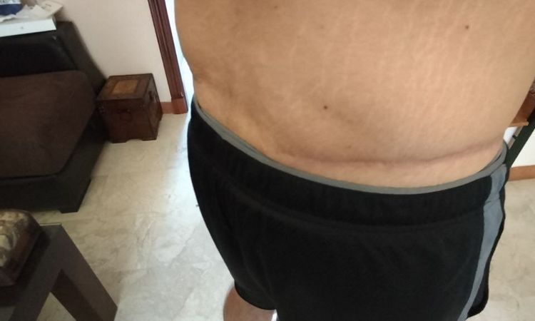 Eliminar grasa localizada en flancos y espalda baja tras abdominoplastia - 52681