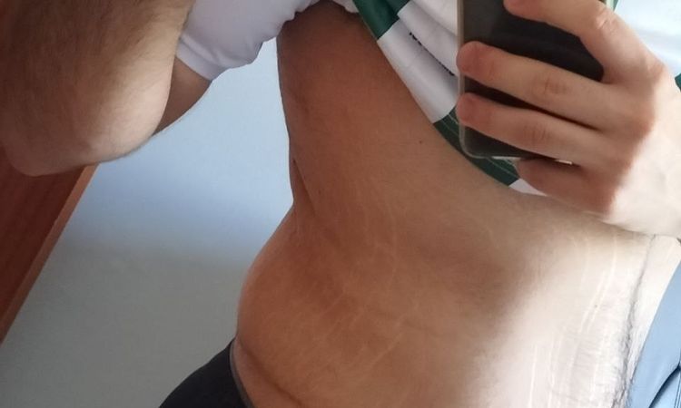 Eliminar grasa localizada en flancos y espalda baja tras abdominoplastia - 52682