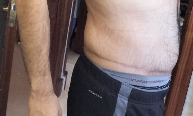Eliminar grasa localizada en flancos y espalda baja tras abdominoplastia - 52683