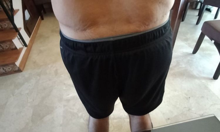 Eliminar grasa localizada en flancos y espalda baja tras abdominoplastia - 52684