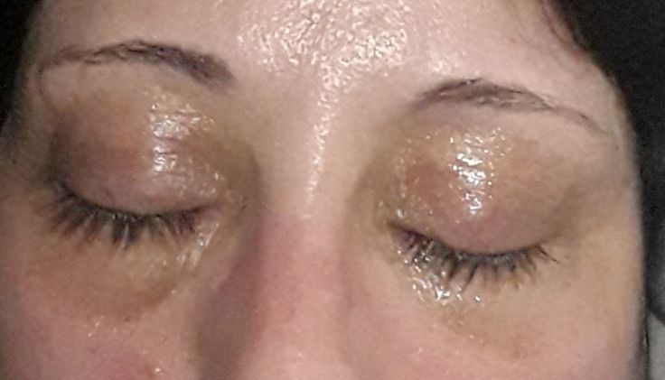 Manchas en ojeras tras blefaroplastia con plasma pen - 52710