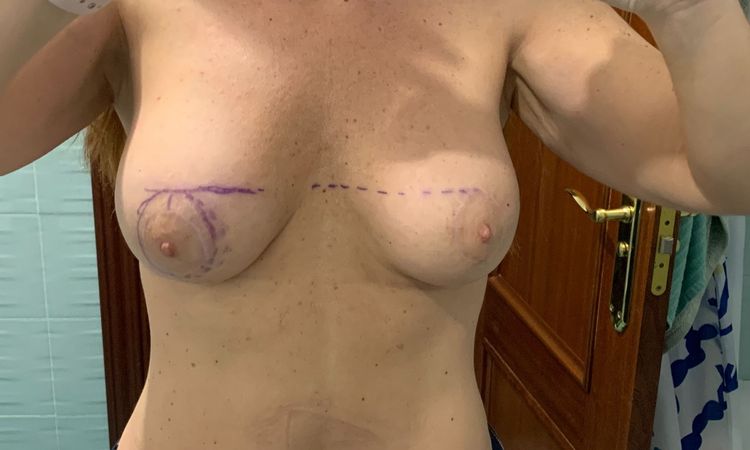 Cómo se puede solucionar un pecho caído a los 6 meses de mastopexia - 52816