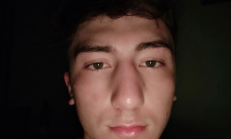 Hinchazón nariz post rinoplastia zona costados de los cornetes - 52902