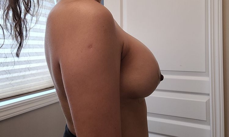 Cuánto tardan en bajar los implantes tras una mastopexia? - 52936