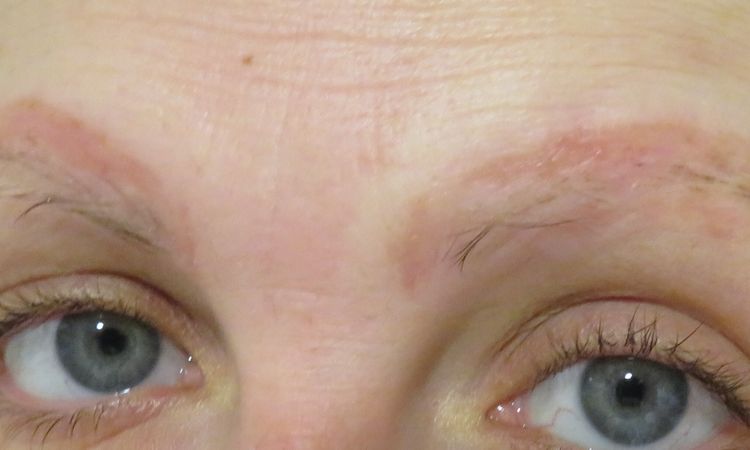 Manchas o cicatriz tras eliminación de microblading con rejuvi - 52982