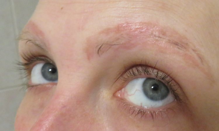 Manchas o cicatriz tras eliminación de microblading con rejuvi - 52983