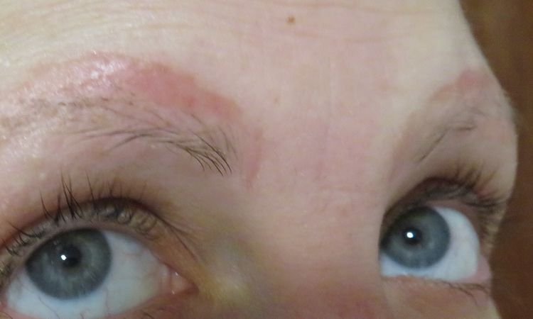 Manchas o cicatriz tras eliminación de microblading con rejuvi - 52984