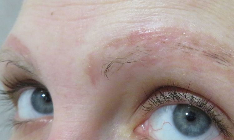 Manchas o cicatriz tras eliminación de microblading con rejuvi - 52985