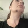 ¿Necrosis o hematoma por ácido hialurónico?
