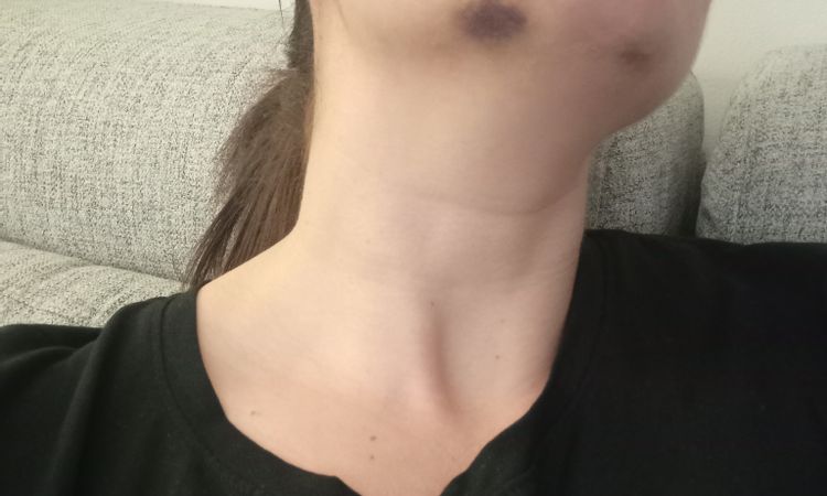 ¿Necrosis o hematoma por ácido hialurónico? - 53002