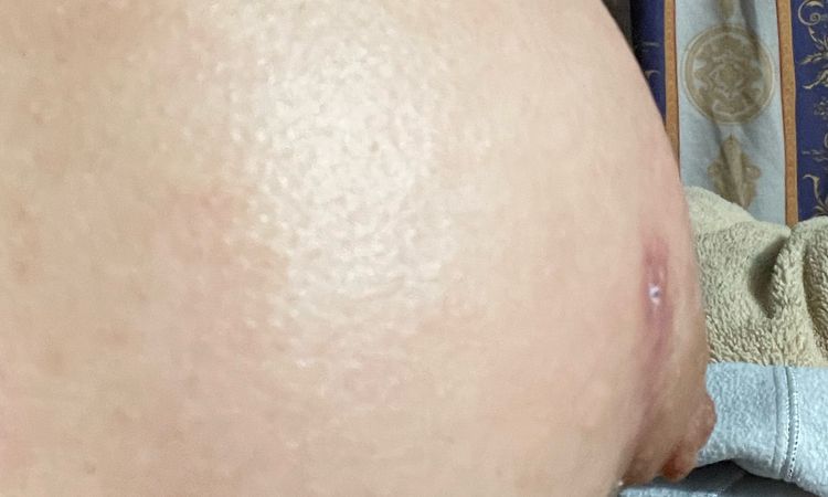 Seno deforme y pezón doblado por la cicatriz tras aumento de pecho - 53008