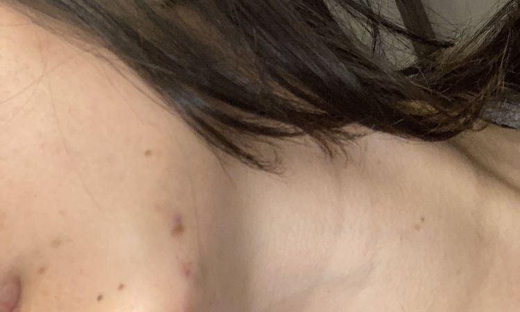 Dolor de cabeza y ejercicio después de rellenos de ácido hialurónico - 53031