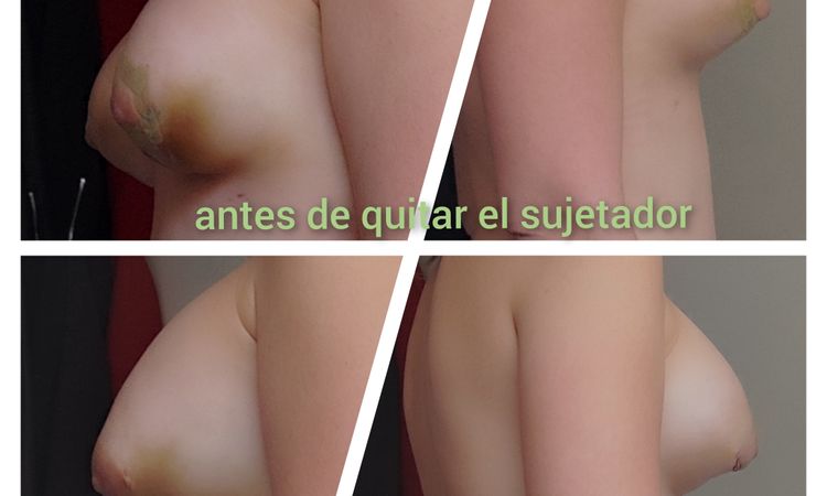 Pezones bajos y prótesis altas tras aumento de pecho en mamas tuberosas - 53057