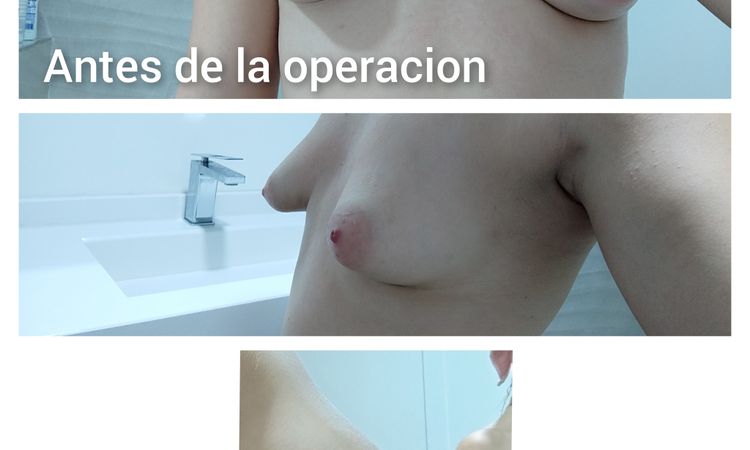 Pezones bajos y prótesis altas tras aumento de pecho en mamas tuberosas - 53059