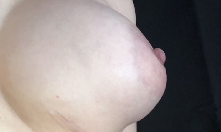 Pecho tuberoso deformado tras un año de aumento de pecho - 53086