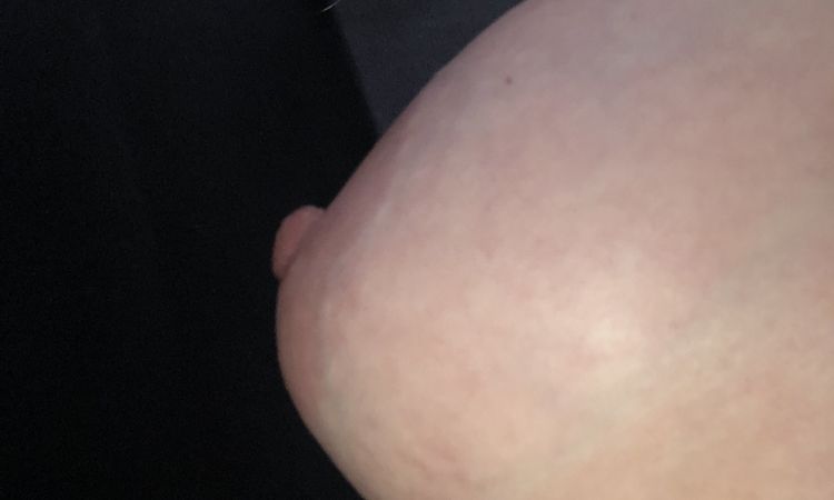 Pecho tuberoso deformado tras un año de aumento de pecho - 53093