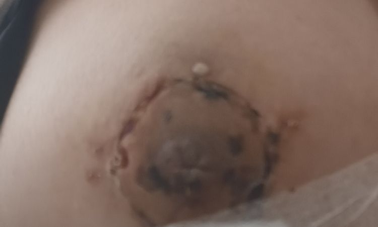 Cicatriz de mastopexia abierta después de 3 semanas en ex fumadora - 53221