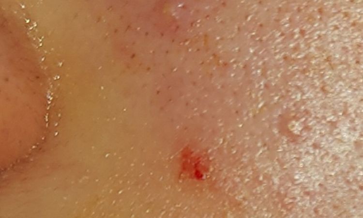 Punto de sangre tras inyección de ácido hialurónico - 53291
