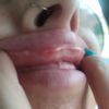 Ampollas en labios tras aplicar ácido hialurónico