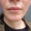 Hendiduras en comisuras tras aumento de labios - 53378