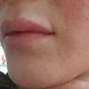 Hendiduras en comisuras tras aumento de labios