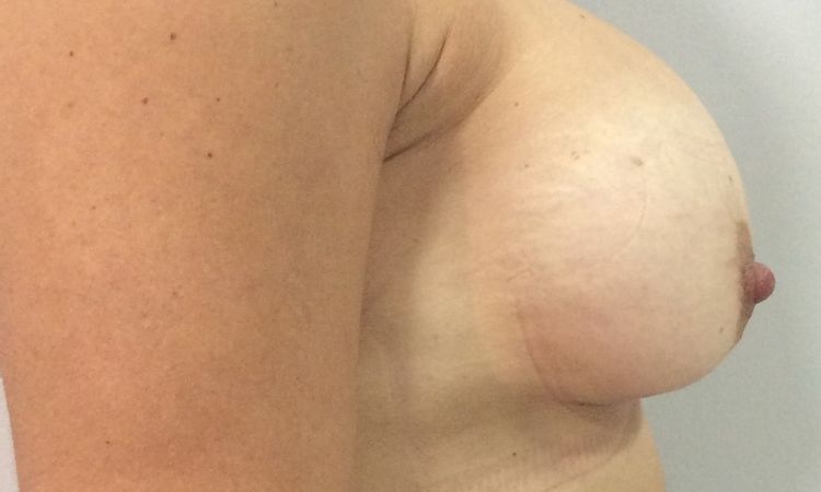 Pezones asimétricos tras segunda intervención con mastopexia periareolar - 53415